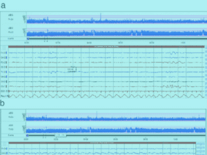Paediatric Stroke Virtual Issue